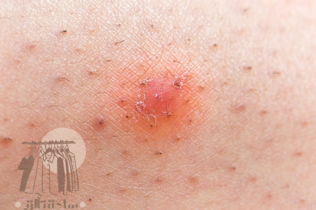 شعر تحت الجلد