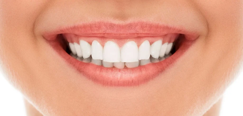 أسعار تلبيس الأسنان الزيركون